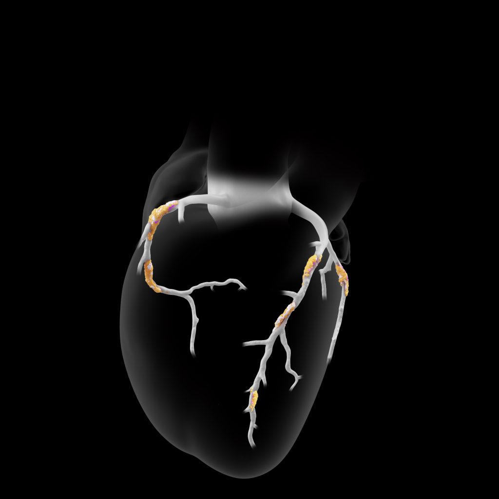 Advanced Plaque Analysis with Heartflow 3D Imaging from MyCardiologist