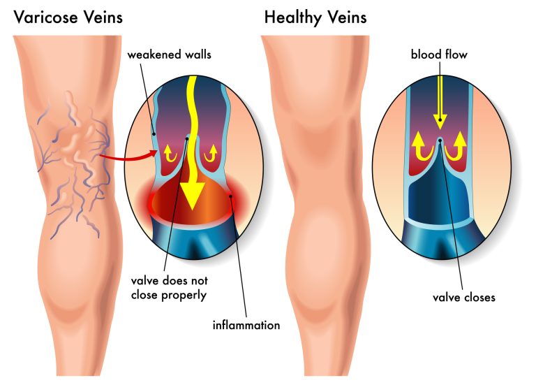 Miami Vericose Vein and Vascular Treatment from MyCardiologist